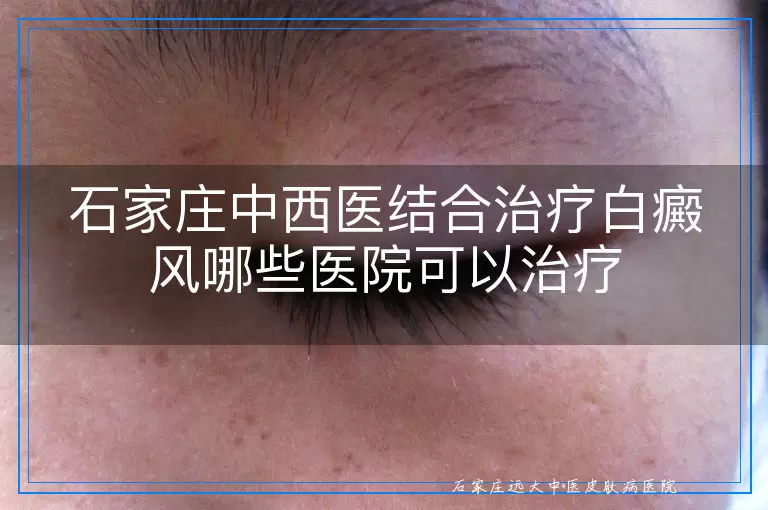 石家庄中西医结合治疗白癜风哪些医院可以治疗