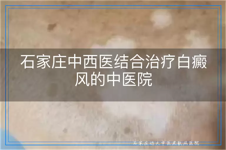 石家庄中西医结合治疗白癜风的中医院