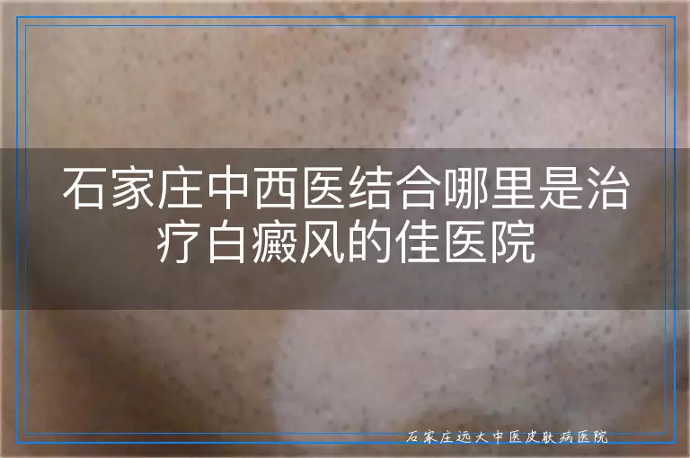 石家庄中西医结合哪里是治疗白癜风的佳医院