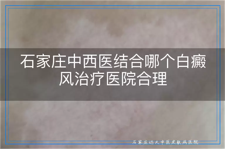 石家庄中西医结合哪个白癜风治疗医院合理