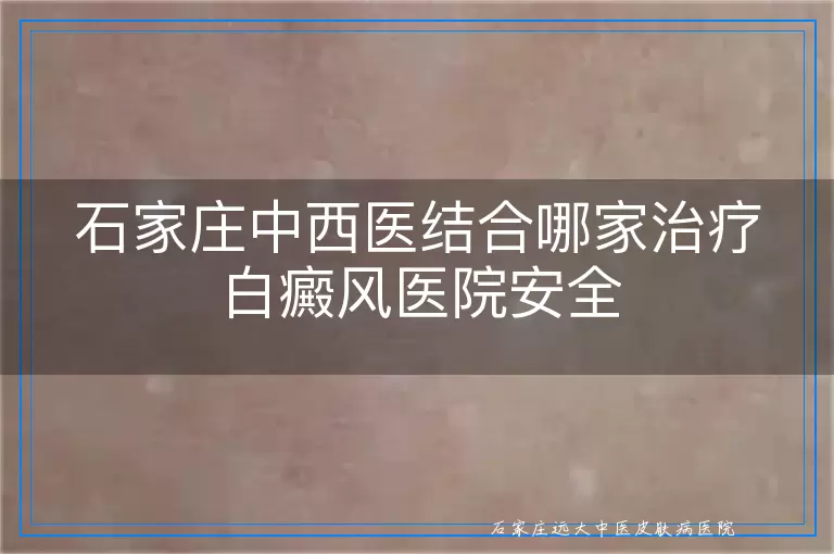 石家庄中西医结合哪家治疗白癜风医院安全