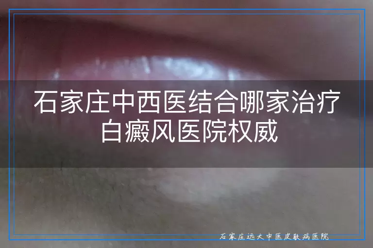 石家庄中西医结合哪家治疗白癜风医院权威