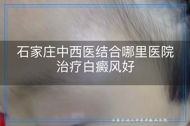 石家庄中西医结合哪里医院治疗白癜风好