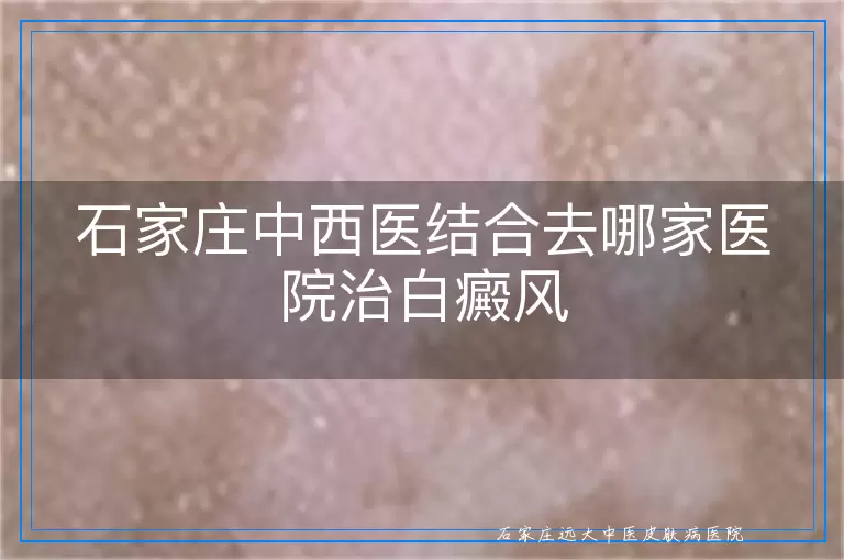 石家庄中西医结合去哪家医院治白癜风