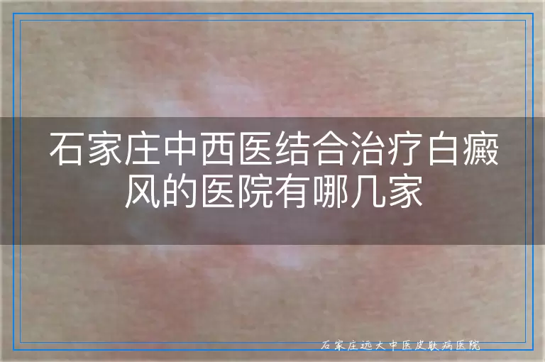 石家庄中西医结合治疗白癜风的医院有哪几家