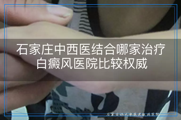 石家庄中西医结合哪家治疗白癜风医院比较权威
