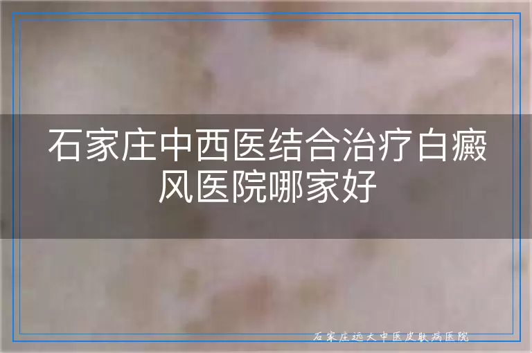 石家庄中西医结合治疗白癜风医院哪家好