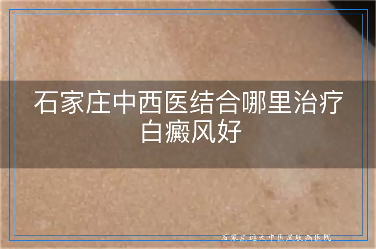 石家庄中西医结合哪里治疗白癜风好