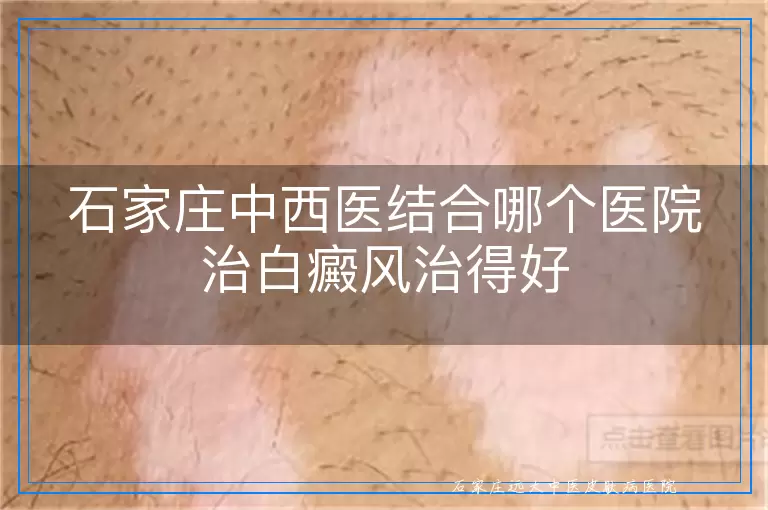 石家庄中西医结合哪个医院治白癜风治得好