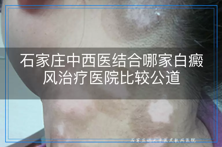 石家庄中西医结合哪家白癜风治疗医院比较公道