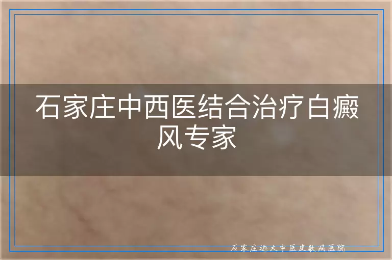 石家庄中西医结合治疗白癜风专家