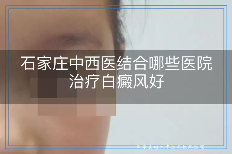 石家庄中西医结合哪些医院治疗白癜风好