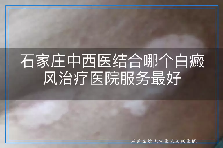 石家庄中西医结合哪个白癜风治疗医院服务最好