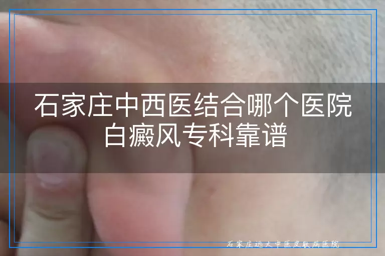 石家庄中西医结合哪个医院白癜风专科靠谱