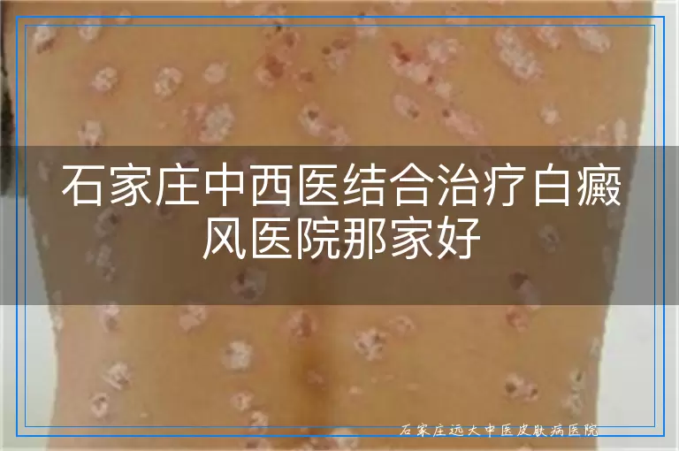 石家庄中西医结合治疗白癜风医院那家好
