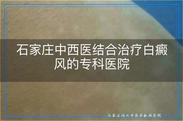 石家庄中西医结合治疗白癜风的专科医院