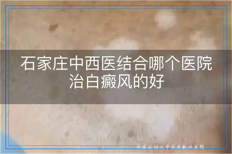 石家庄中西医结合哪个医院治白癜风的好