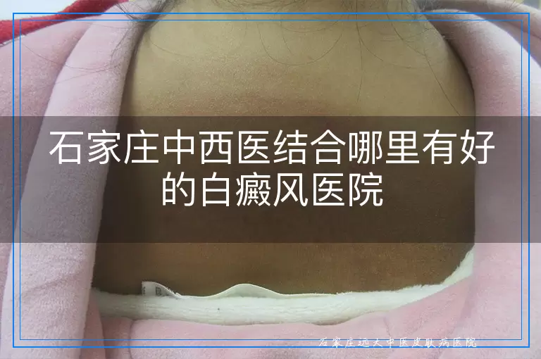石家庄中西医结合哪里有好的白癜风医院