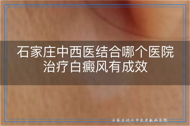 石家庄中西医结合哪个医院治疗白癜风有成效