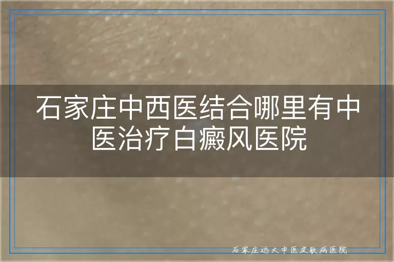 石家庄中西医结合哪里有中医治疗白癜风医院