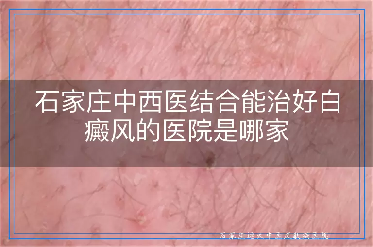 石家庄中西医结合能治好白癜风的医院是哪家