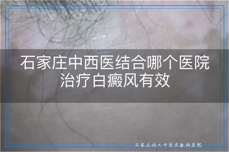 石家庄中西医结合哪个医院治疗白癜风有效