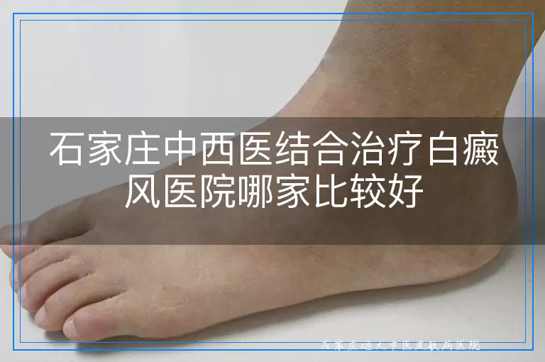 石家庄中西医结合治疗白癜风医院哪家比较好