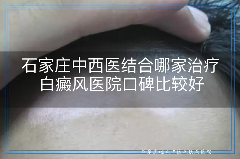 石家庄中西医结合哪家治疗白癜风医院口碑比较好