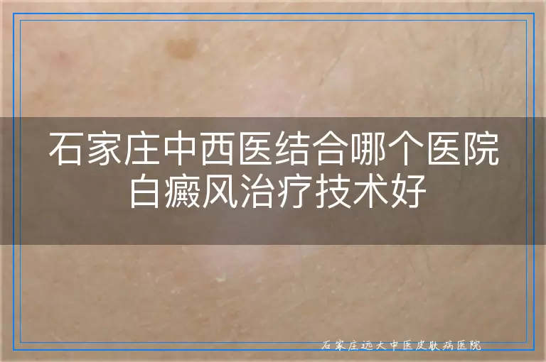 石家庄中西医结合哪个医院白癜风治疗技术好