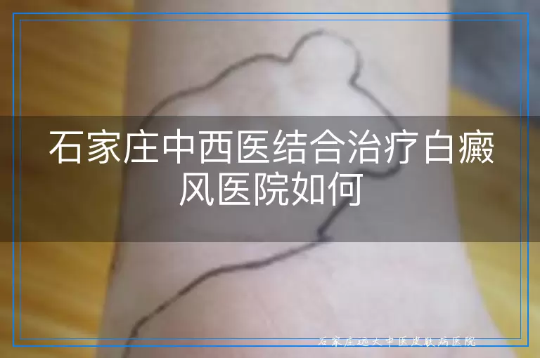 石家庄中西医结合治疗白癜风医院如何