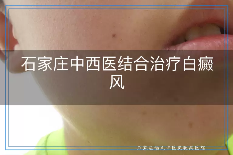 石家庄中西医结合治疗白癜风