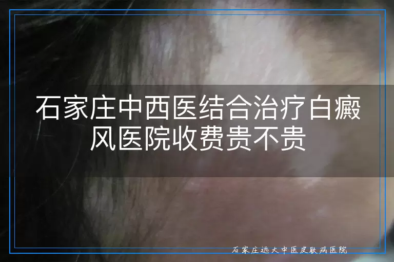 石家庄中西医结合治疗白癜风医院收费贵不贵