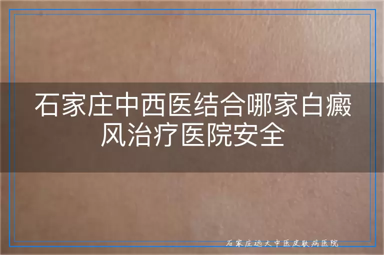 石家庄中西医结合哪家白癜风治疗医院安全