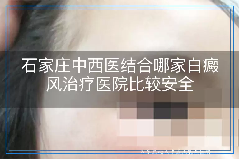 石家庄中西医结合哪家白癜风治疗医院比较安全