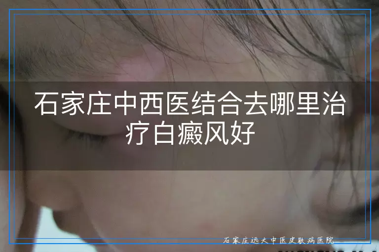 石家庄中西医结合去哪里治疗白癜风好