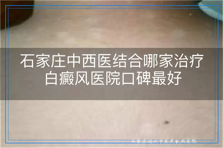 石家庄中西医结合哪家治疗白癜风医院口碑最好