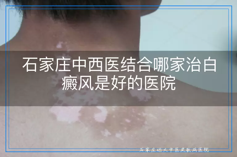 石家庄中西医结合哪家治白癜风是好的医院