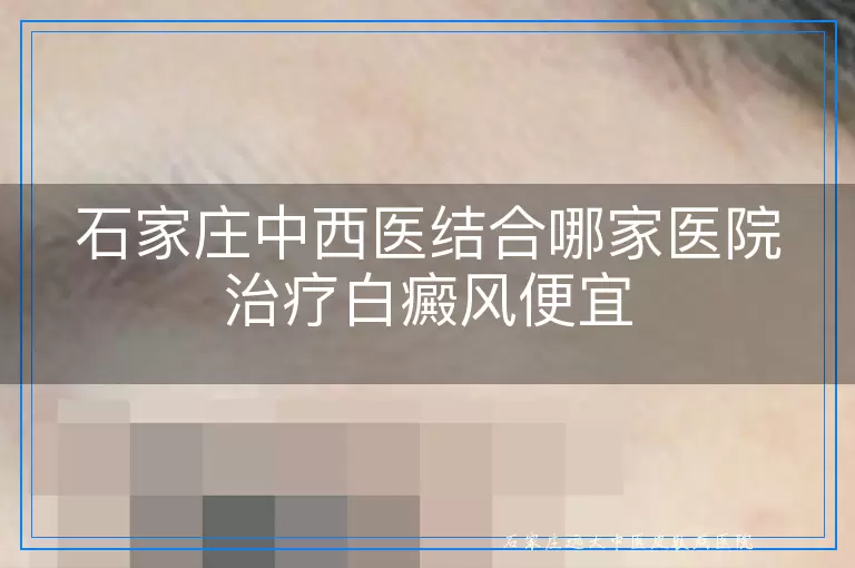 石家庄中西医结合哪家医院治疗白癜风便宜