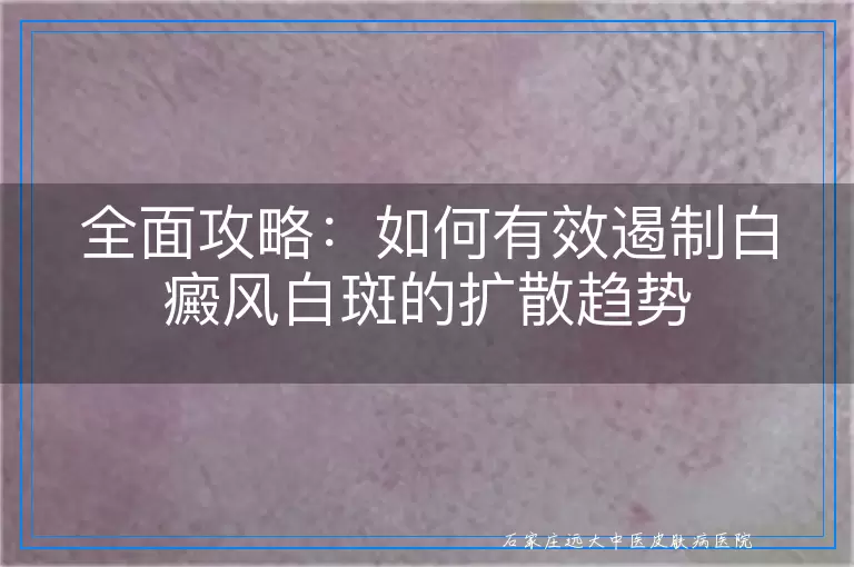 全面攻略：如何有效遏制白癜风白斑的扩散趋势