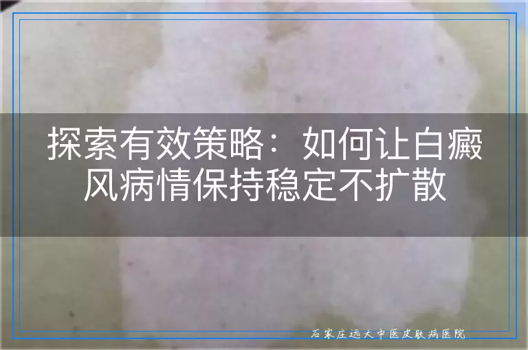 探索有效策略：如何让白癜风病情保持稳定不扩散