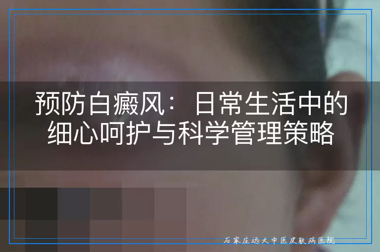 预防白癜风：日常生活中的细心呵护与科学管理策略