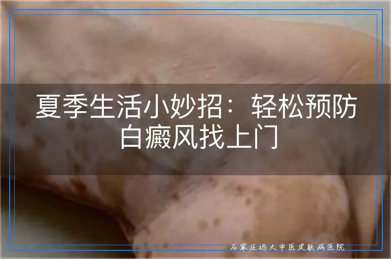 夏季生活小妙招：轻松预防白癜风找上门