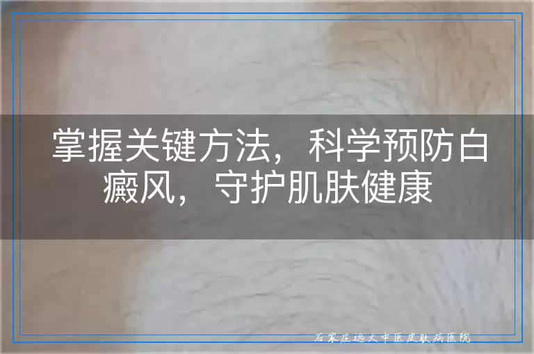 掌握关键方法，科学预防白癜风，守护肌肤健康