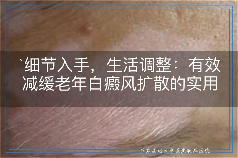 细节入手，生活调整：有效减缓老年白癜风扩散的实用指南