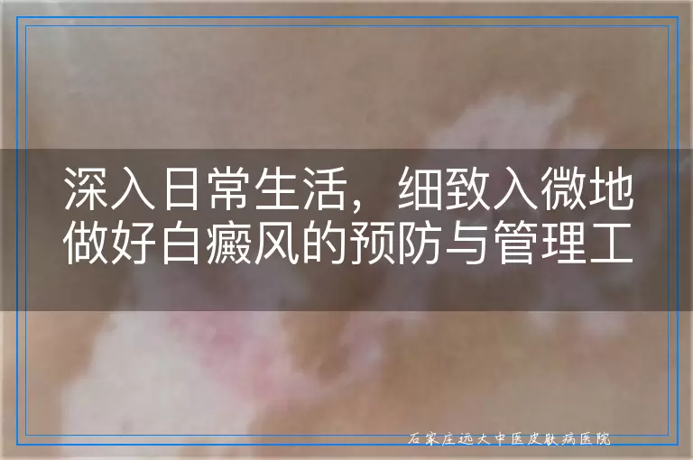 深入日常生活，细致入微地做好白癜风的预防与管理工作