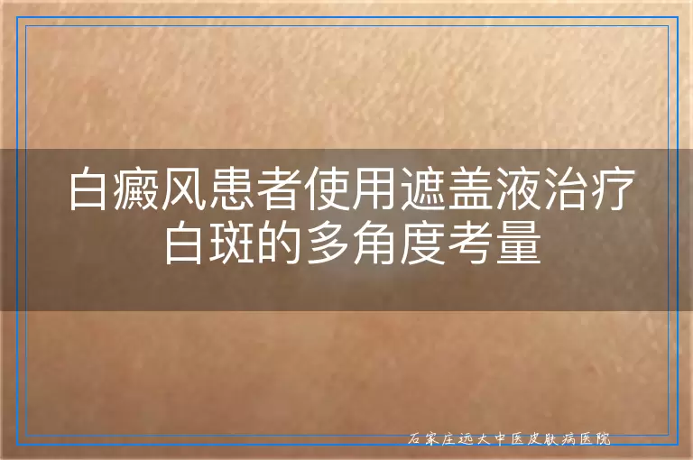 白癜风患者使用遮盖液治疗白斑的多角度考量