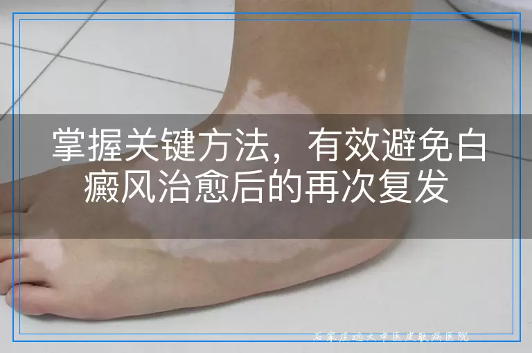 掌握关键方法，有效避免白癜风治愈后的再次复发