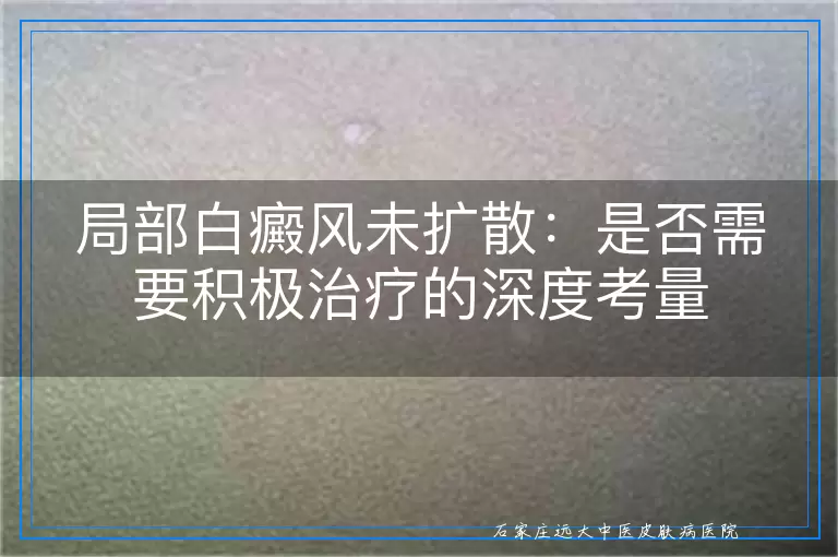 局部白癜风未扩散：是否需要积极治疗的深度考量