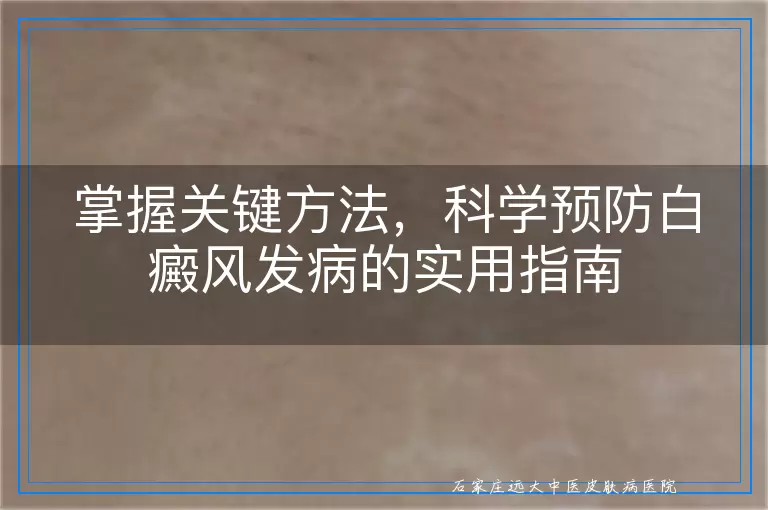 掌握关键方法，科学预防白癜风发病的实用指南