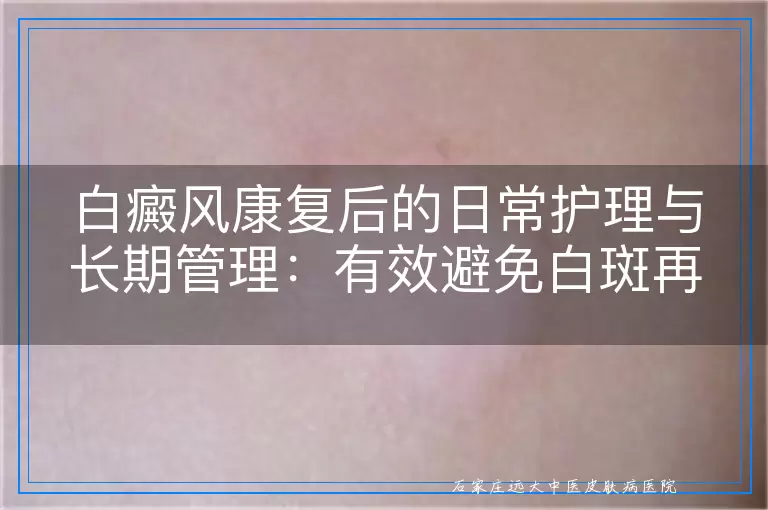 白癜风康复后的日常护理与长期管理：有效避免白斑再度出现的实用指南